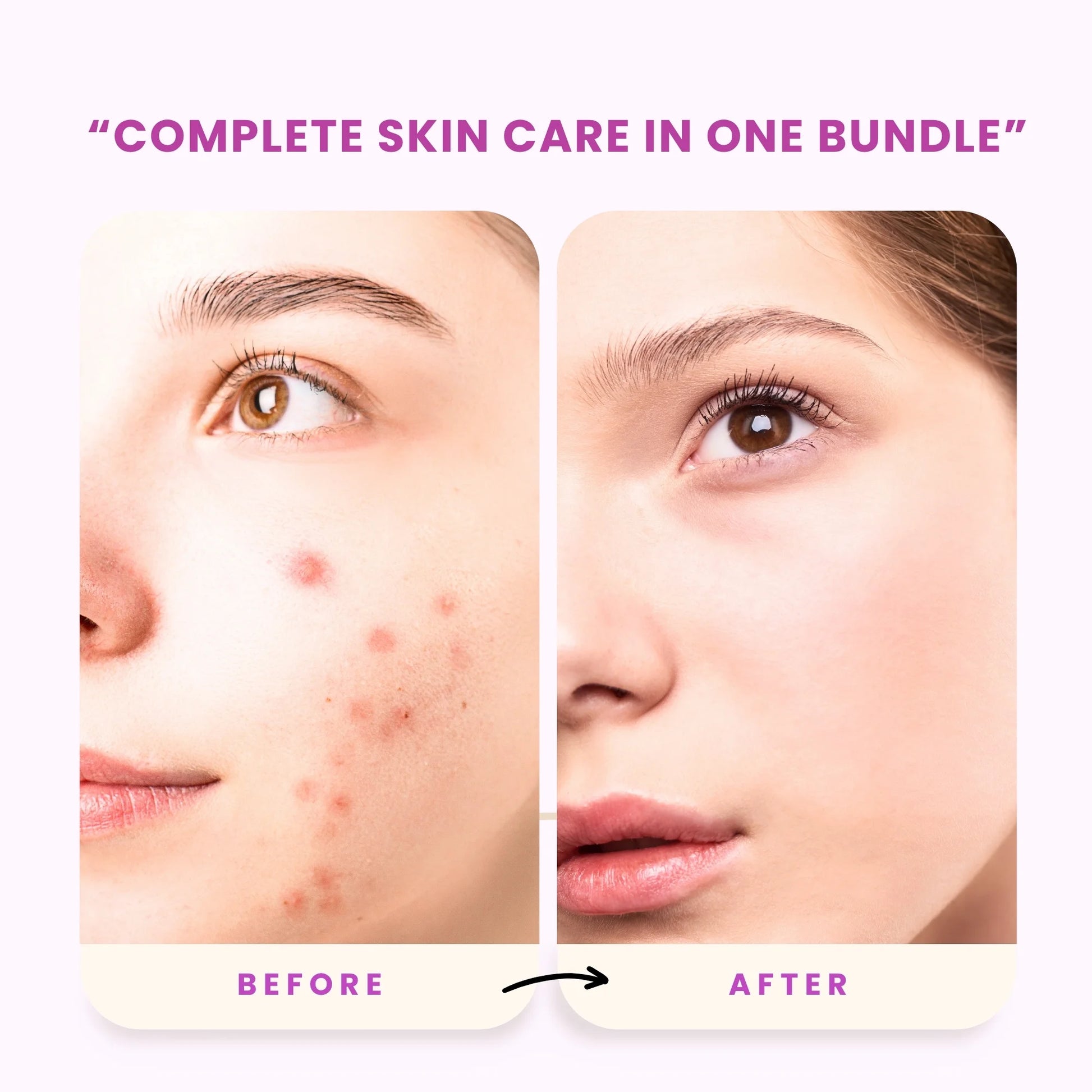 Before and after comparison of skin care treatment with text 'Complete skin care in one bundle'.