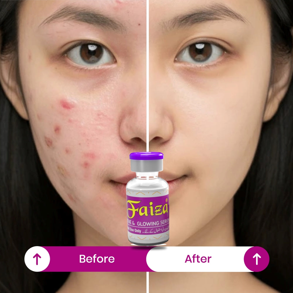Before and After using Faiza Acne & Glowing Serum showing clear skin results after treating severe pimples and blemishes.