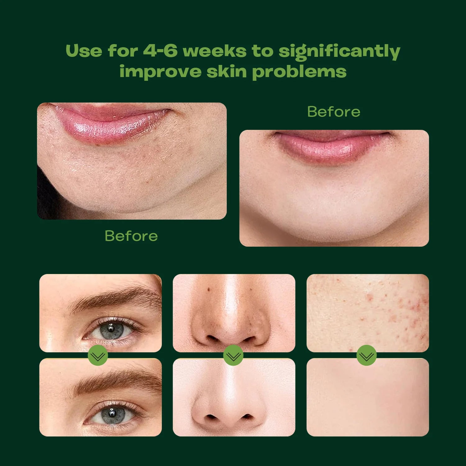 Before & After collage showing how the Menthol Ice Face Wash significantly improves skin problems after 4-6 weeks of use.