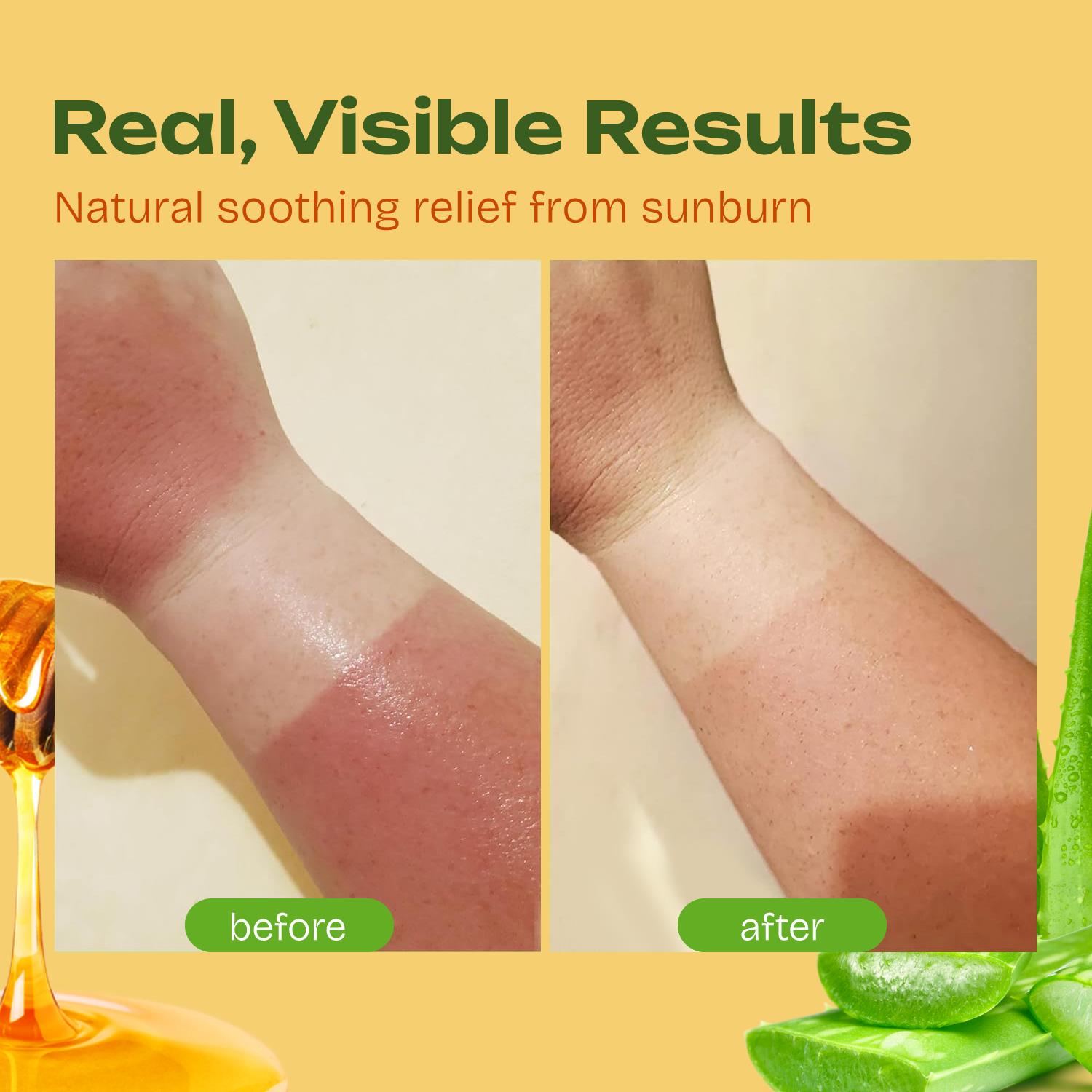 Before and After image showing Real, Visible Results for natural soothing relief from sunburn.